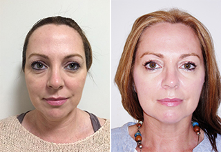 Non Surgical 8 Point Face Lift