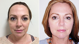 dermal Fillers Torquay, Dermal Fillers Devon