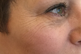 Botox to eyes/crows feet before