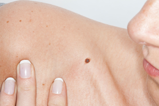 Skin Tag Removal